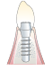 インプラント治療