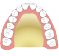 金属床義歯