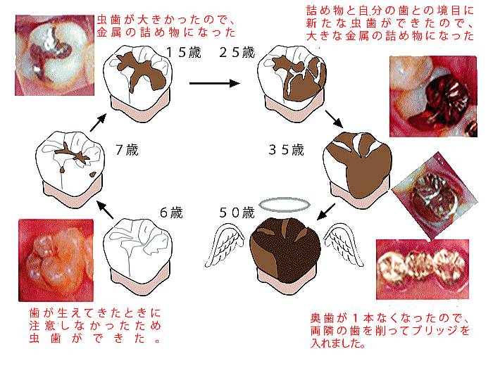 削ってしまった歯の一生