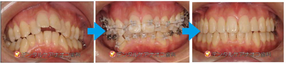 三次元矯正症例2