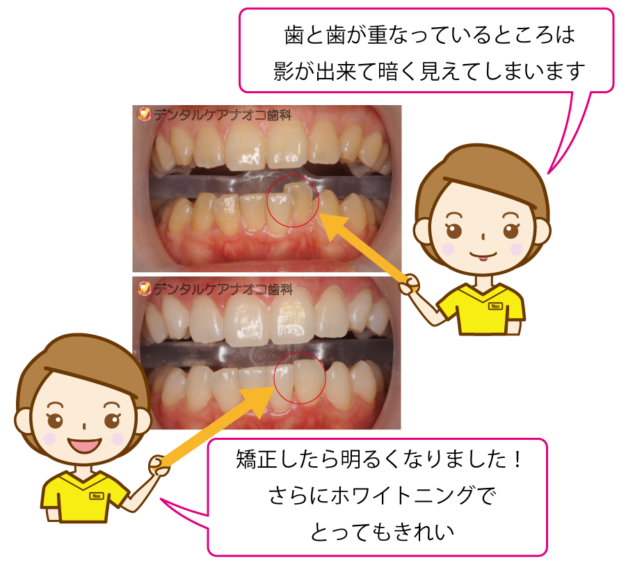 歯並びとホワイトニング